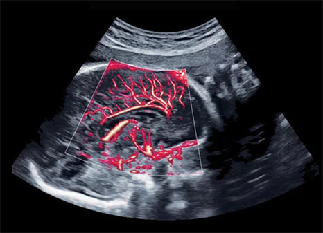 hera-ultrasound.jpg